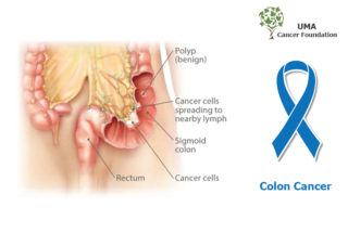 Colon-Cancer