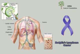 Hodgkin's_Lymphoma_Cancer