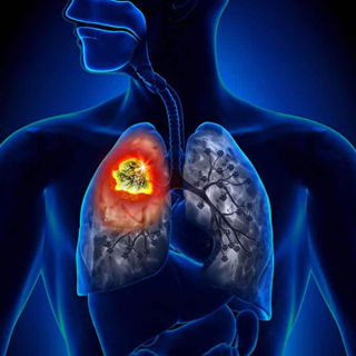 Lung Cancer treatment in hyderabad