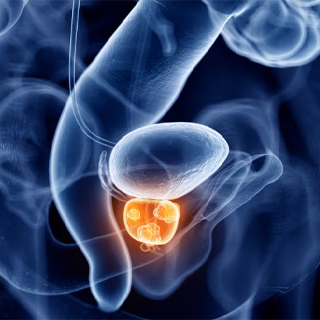 Prostate cancer treatment in Hyderabad