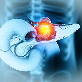 pancreatic cancer treatment in Hyderabad
